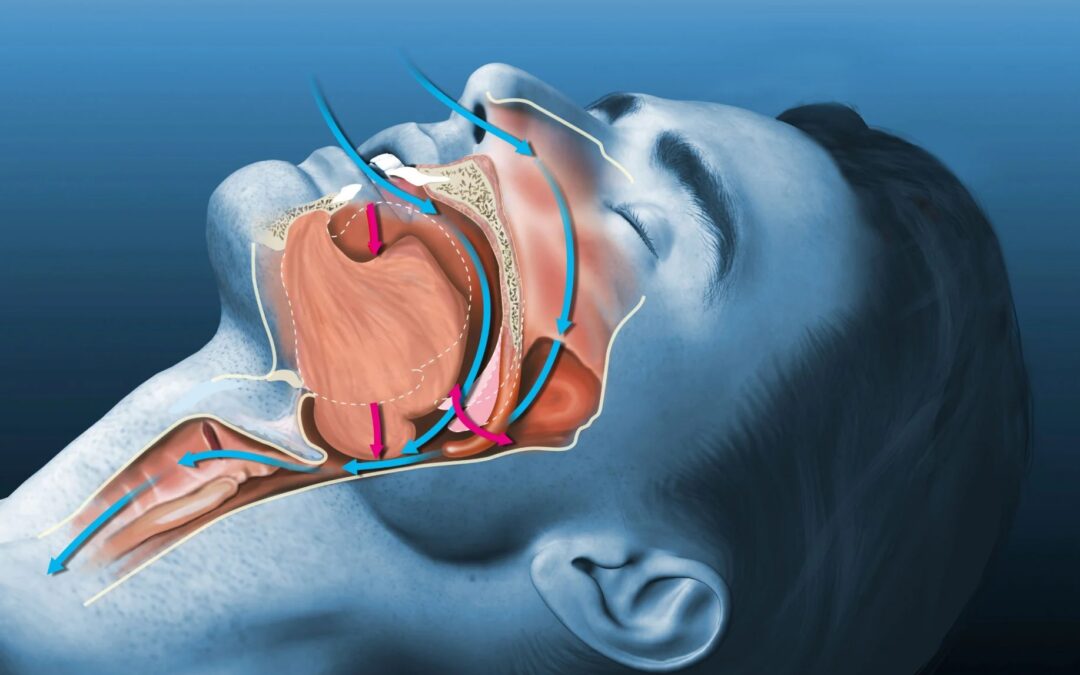 Sleep Apnea Clinical Trials: A Fitness Professional’s Analysis of Treatment Innovations